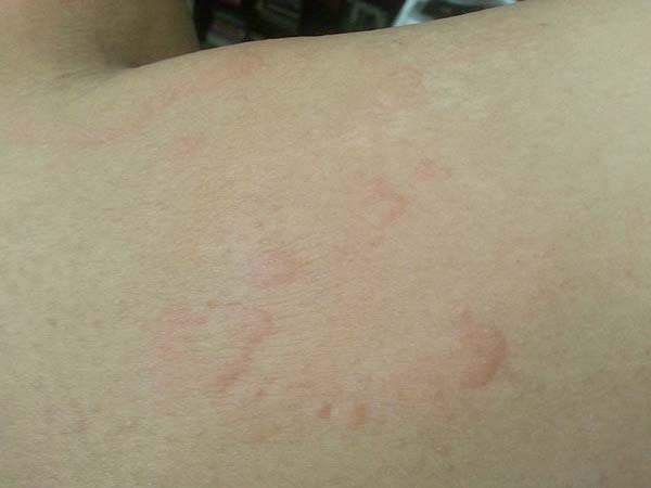 450px-Cold_urticaria4.jpg