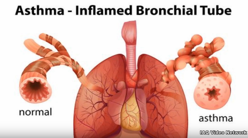 asthma2.jpg